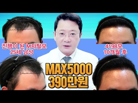 모발이식 M자탈모 진행이 된 경우 증모술을 병행합니다. MAX5000 390만원 모발이식 후 10개월 루트