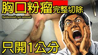 只開1公分!胸口粉瘤完整切除|仔細剝離囊壁、檢查有否殘留|皮膚科醫生手術實錄