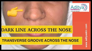 DARK LINE ACROSS THE NOSE | PIGMENTATION ON NOSE | TRANSVERSE NESAL GROOVE | LASER TREATMENT by DR .