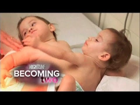 Conjoined Twins, Erika & Eva Sandoval Successfully Separated Video