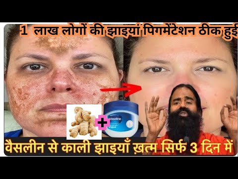 How to remove dark spots with ginger, the right way. Reduce Melasma, Pigmentation, Discolouration...