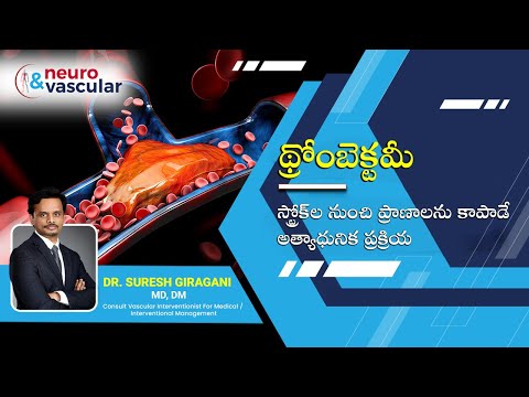 మేజర్ బ్రెయిన్ స్ట్రోక్‌లకు అత్యాధునిక చికిత్స థ్రోంబెక్టమీ: డాక్టర్ సురేష్ గిరగాని