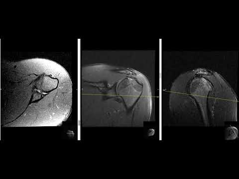 23 year old male with shoulder pain