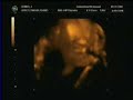 Ultrasound: Bouncing around the womb