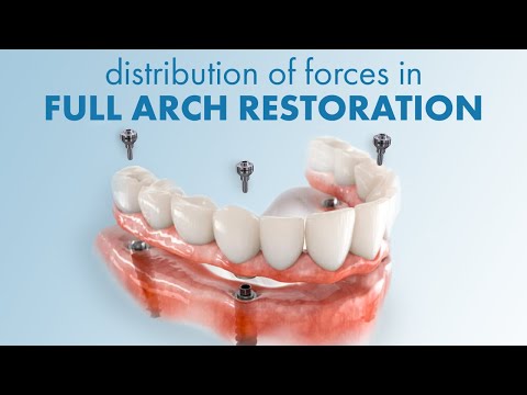 A case where we have a full jaw restoration. We have a cross arch bridge on the lower jaw