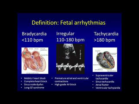 Fetal Arrhythmias and Management by David W. Brown, M.D., FAAP