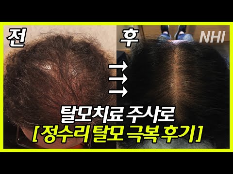 ★탈모치료 주사로 극복한 정수리 탈모 후기★｜뉴헤어