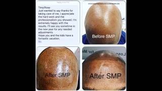 The Scalp Micropigmentation Center of Toronto are the Leaders in the SMP Industry in Canada.