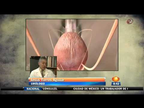 Diane Pérez: vejiga hiperactiva