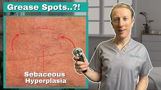 How to Get Rid of Sebaceous Hyperplasia: Complete Guide to Sebaceous Hyperplasia