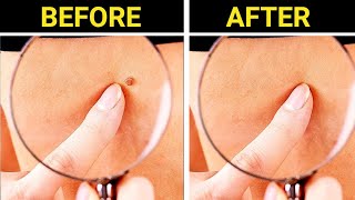 9 Effective Ways To Remove Skin Tags At Home