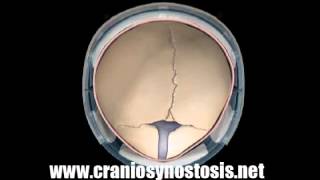 Metopic Synostosis Helmet Therapy (Growth Superior) - Craniosynostosis Surgery