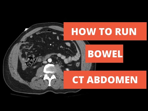 How to read a CT - Approach to Running Bowel