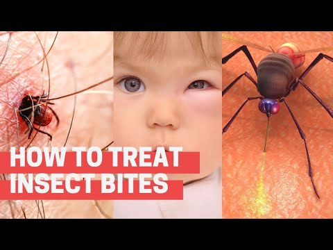 🕷️ How to Treat Insect Bites and Spider Stings at Home?