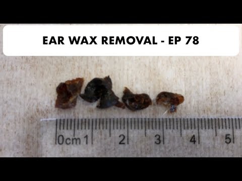 3.5CM EAR WAX REMOVED - EP 78