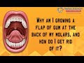 A flap of gum growing at the back of my molars - How do i get rid of it? Carrollton Surgeon Vadivel