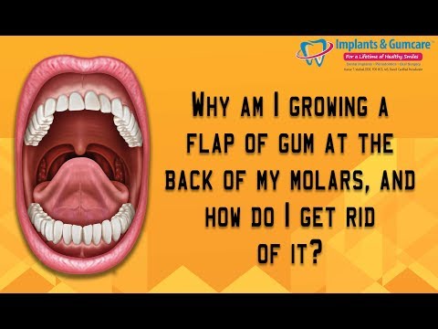 A flap of gum growing at the back of my molars - How do i get rid of it? Carrollton Surgeon Vadivel Video