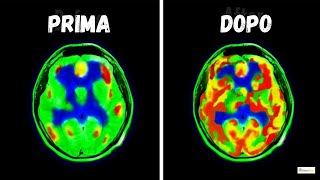🧠 Come la DOPAMINA ha cambiato il mio CERVELLO