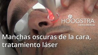 Manchas oscuras de la cara, tratamiento láser (15044)
