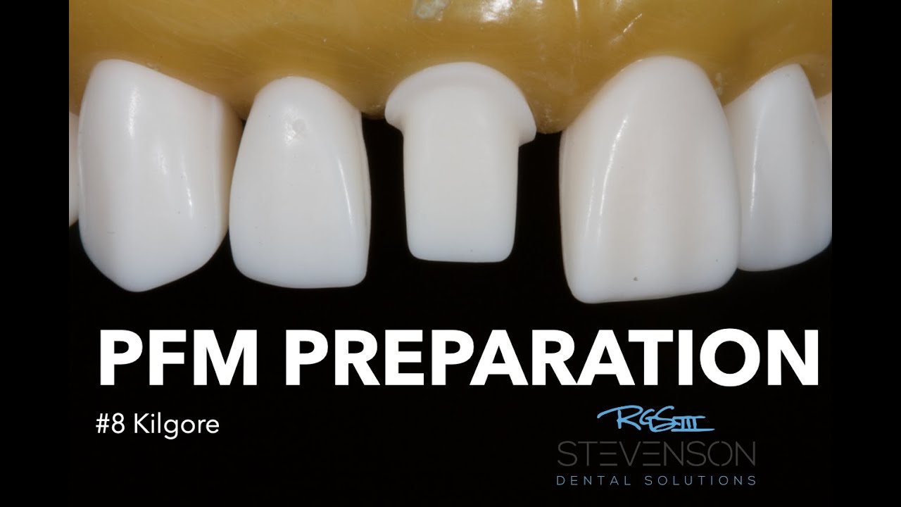 PFM Preparation for #8 Kilgore | Stevenson Dental Solutions