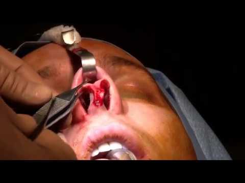 Rhinoplasty Patient Experience Video #4 Surgery day