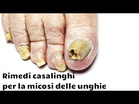 Come imparare è o non i vermi Da che vermi avente fame