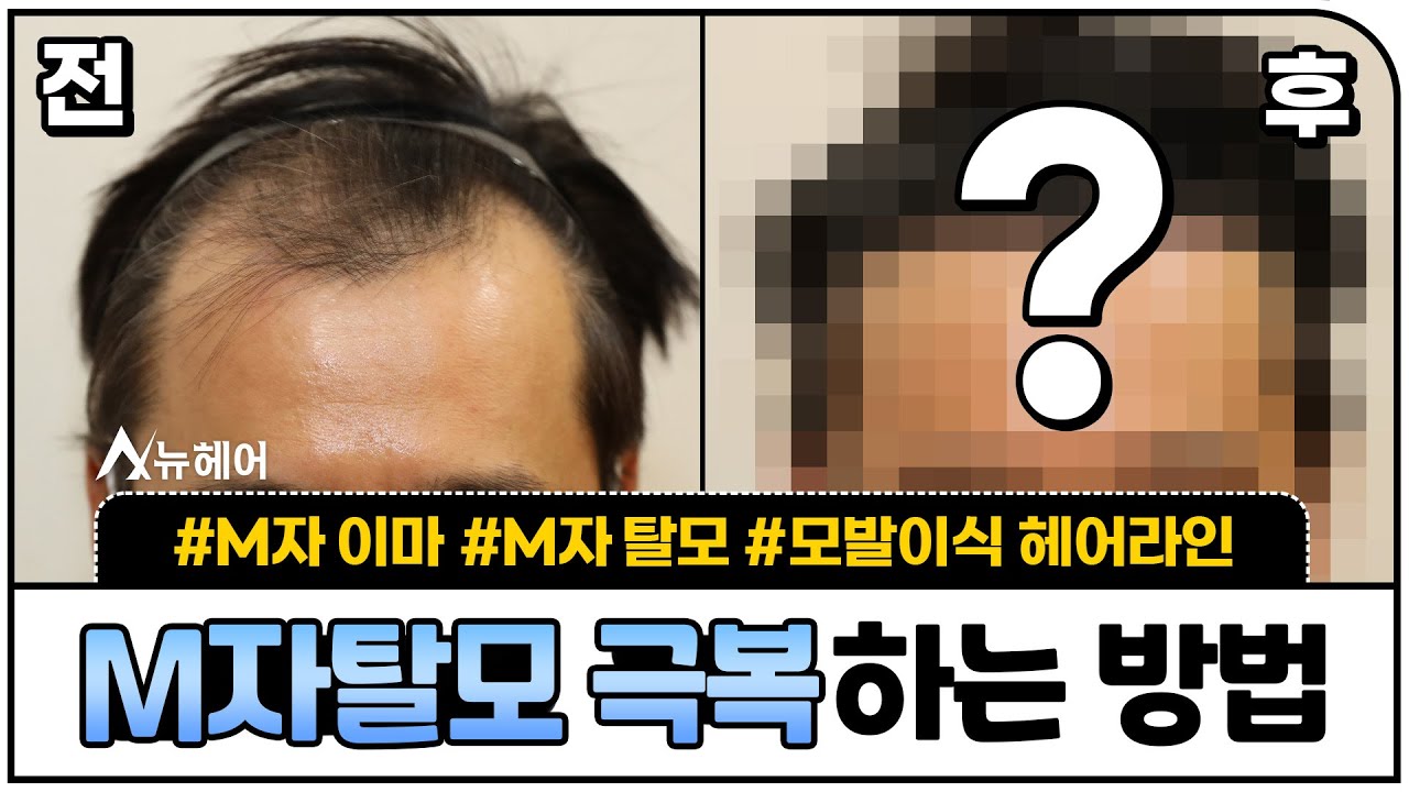 M字脱发克服方法！毛发移植1年真实后期 ㅣ1400~2000毛囊 ㅣ New Hair