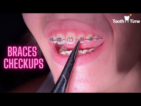 Braces Checkups - Tooth Time Family Dentistry New Braunfels