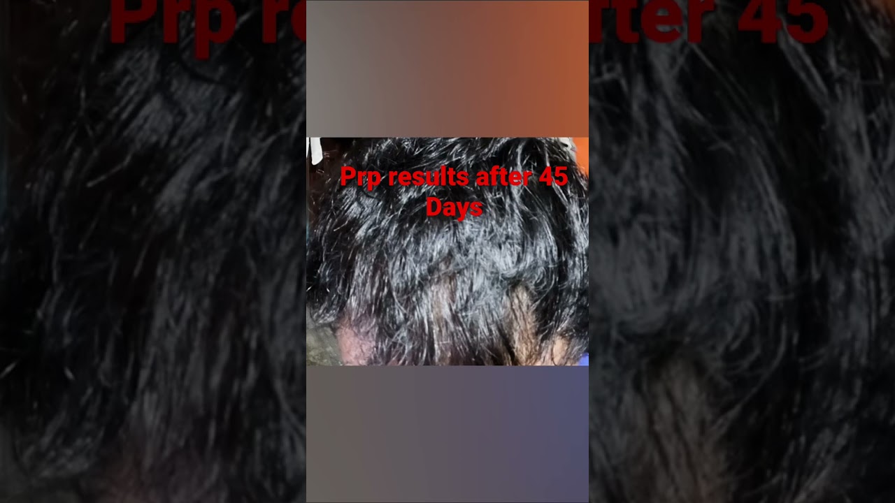 PRP RESULTS AFTER 2nd prp.