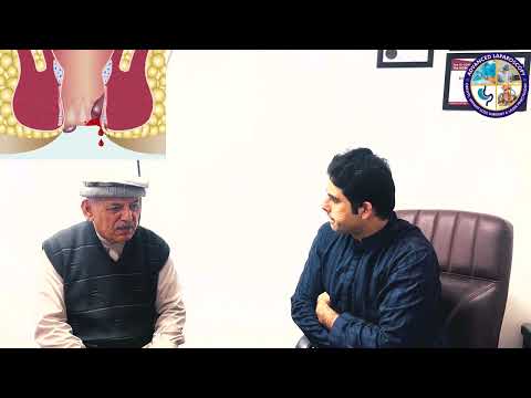 Laser Hemorrhoidoplasty for grade 4 Piles