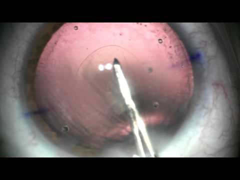 Capsulorhexis postérieur pour une plaque de fibrose et ablation de l'huile de silicone (partie 1) 