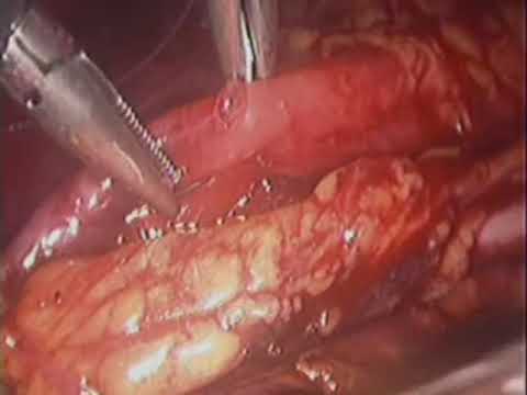 laparoscopic ureterolysis-λαπαροσκοπικη ουρητηρόλυση