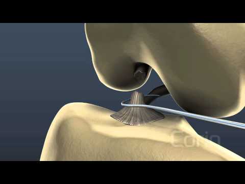 ACL Reconstruction Using the LARS Ligament