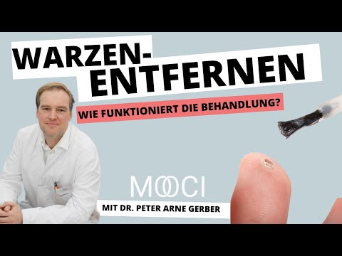 Warzen entfernen - Wie geht das?