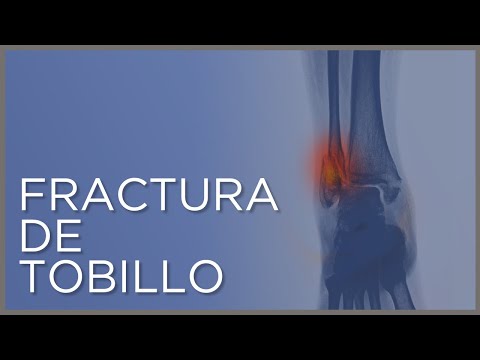 FRACTURA DE TOBILLO. Todo lo que tienes que saber: #causas, #síntomas y #tratamiento