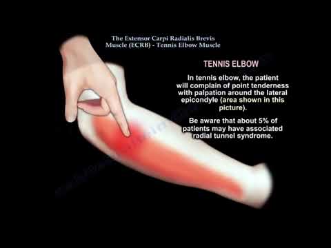 Łokieć tenisisty – rozważania kliniczne i anatomiczne