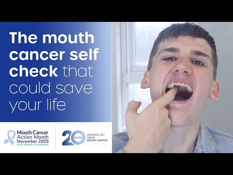 Health Tips: How to Screen For Oral Cancer At Home