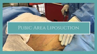 Pubic Area Liposuction