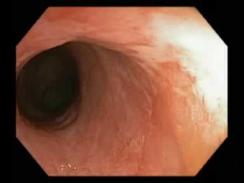 Asymptomatic distal colitis sparing lower rectum Video