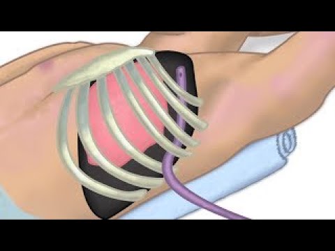 "Chest Tube Placement" by Chris Weldon for OPENPediatrics Video