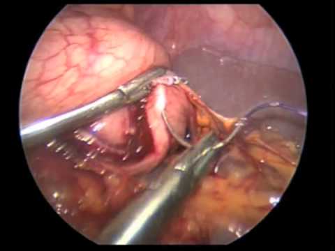 Laparoskopische subtotale Gastrektomie - GIST