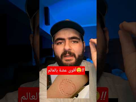 أقوى عضة بالعالم مش الأسد!!(صادم جدا)😲