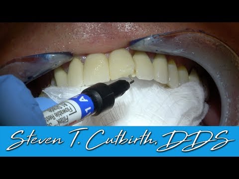 How to Bond a Chipped Porcelain Bridge - Dental Minute with Steven T. Cutbirth, DDS