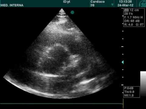 Bicuspid Aorta View In Doppler Echocardiography 