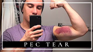 How I RECOVERED from Pec Tear Surgery in ONLY 4 MONTHS