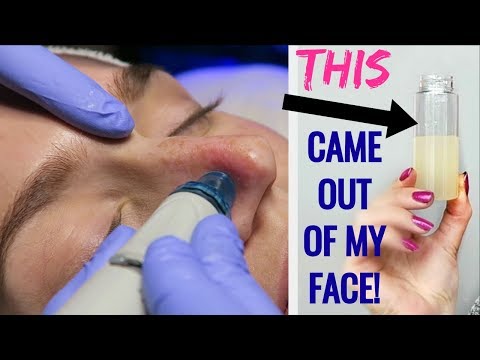 Getting My Pores SUCKED CLEAN! My First Hydra Facial Experience Video