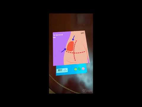 INYECCIÓN INTRAMUSCULAR 1