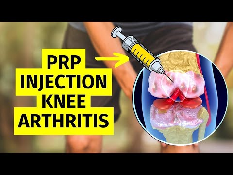 Can PRP Injections STOP Knee Arthritis from Worsening?