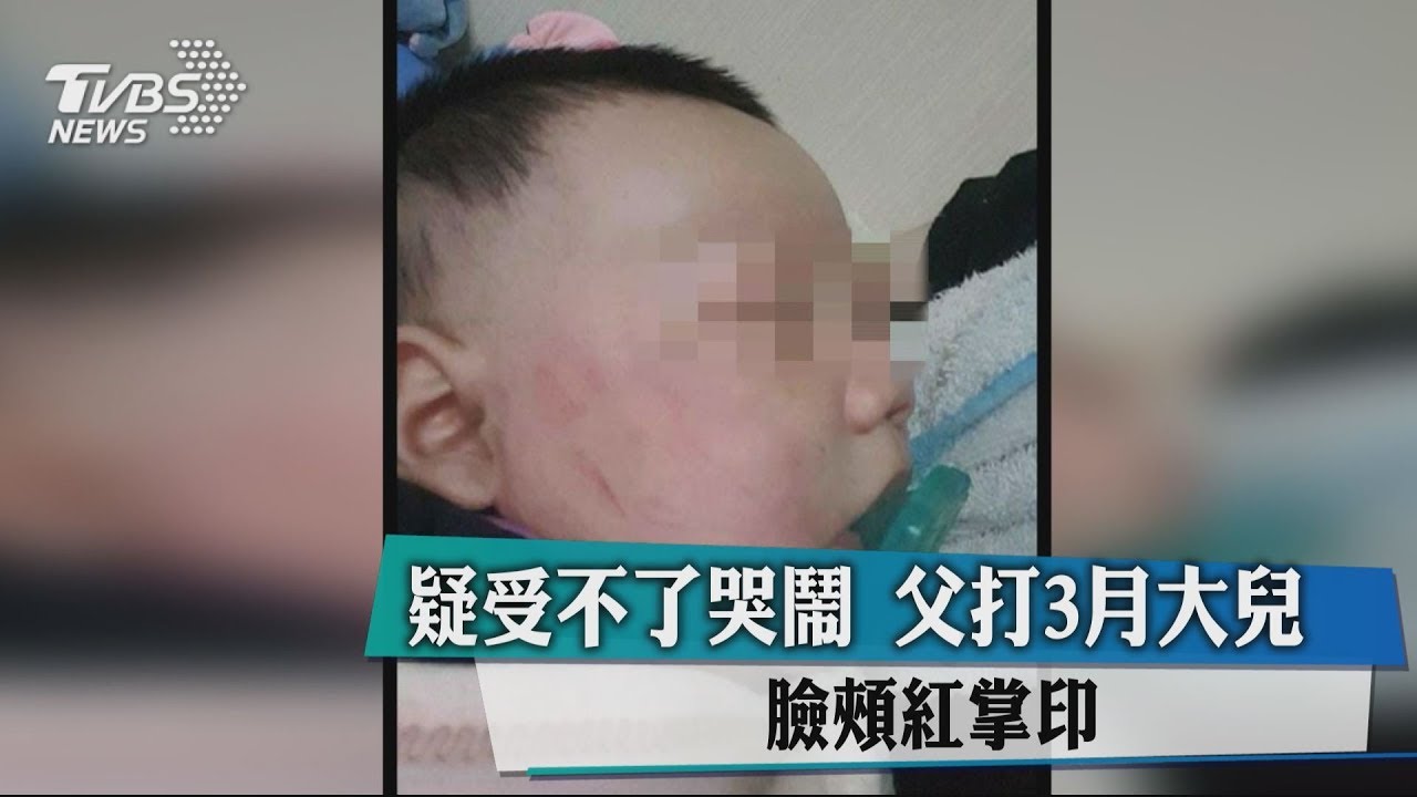 疑受不了哭鬧 父打3月大兒臉頰紅掌印