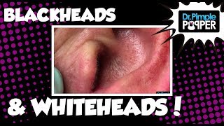 The Good, the Bad, the Great Blackheads &amp; Whiteheads
